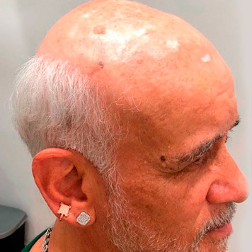 protese-capilar-masculino