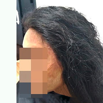 protese-capilar-feminina
