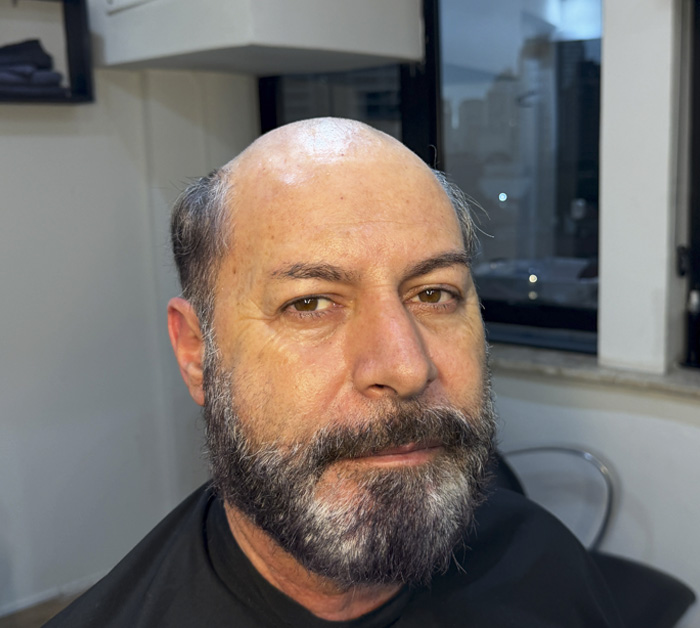 Antes da Prótese Capilar
