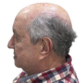 Prótese capilar masculino protese-capilar-masculino