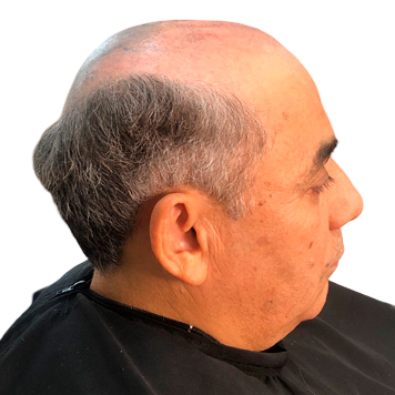 Prótese capilar masculino protese-capilar-masculino
